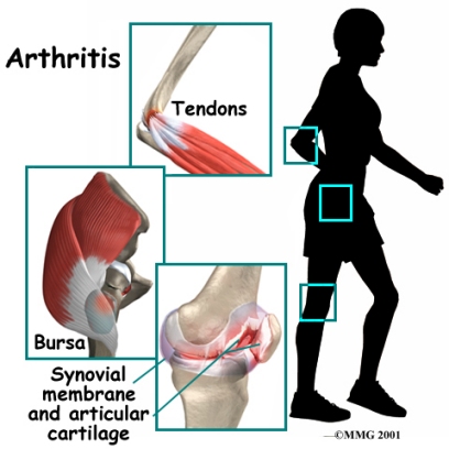 arthritis.jpg