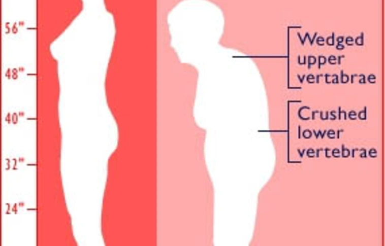 Új ismeretek az ízületi gyulladásról és a csontritkulásról