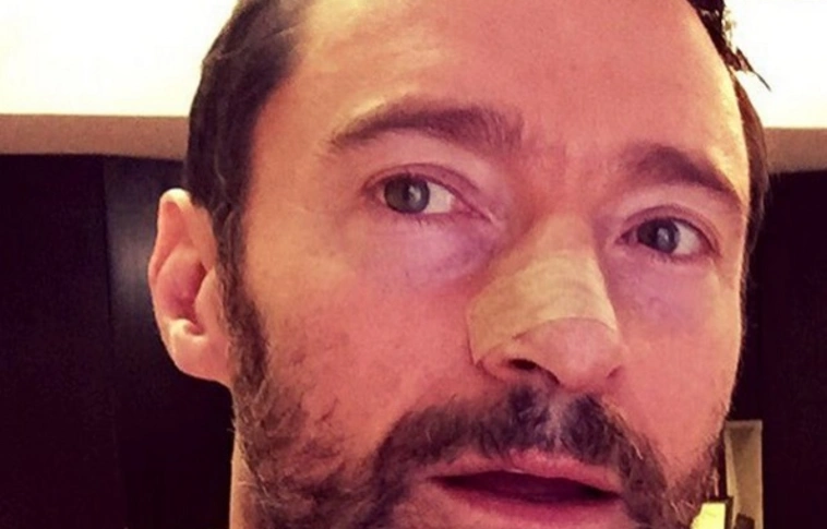 Az életben is sok mindennel küzd a farkasember,  Hugh Jackman bőrdaganata kiújult 