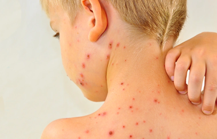 Belehalt a kanyarófertőzésbe egy kárpátaljai gyerek