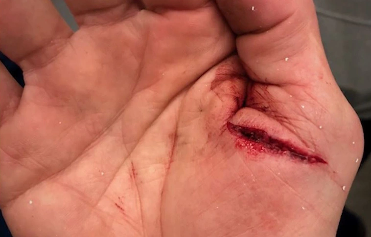 Krimibe illő történet – korábbi sérülése buktatta le