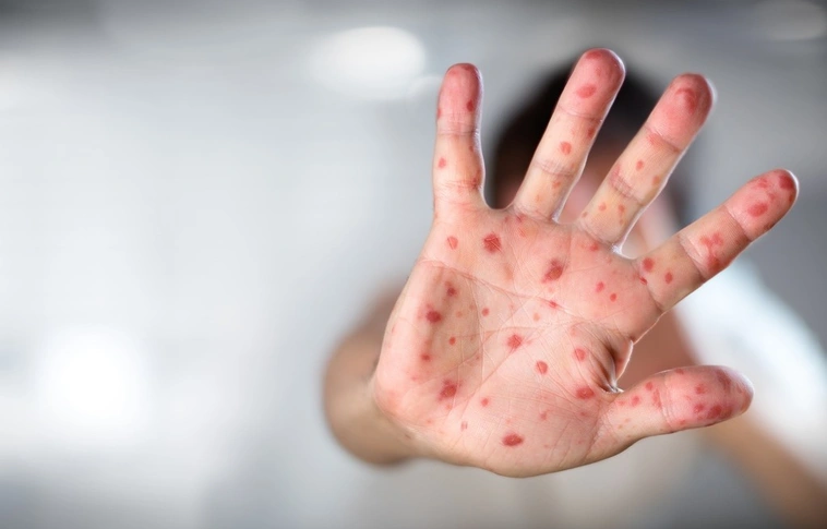 Rendkívüli állapotot hirdettek a kanyaró miatt egy kórházban